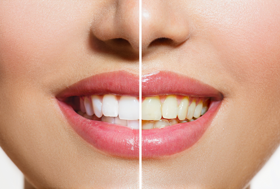 Teeth Whitening | Dentist In San Jose, CA | Lorna L. Okada, D.D.S.