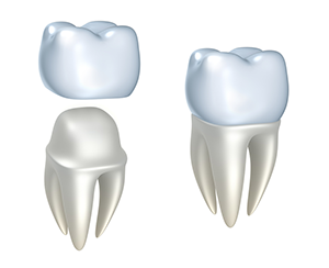 CEREC Crowns | Dentist In San Jose, CA | Lorna L. Okada, D.D.S. 
